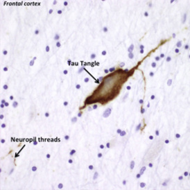 TBI Research