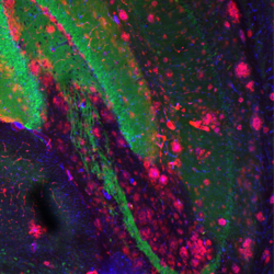 amyloid alzheimers.jpg
