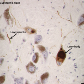 Parkinsons Research