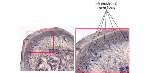 Peripheral Neuropathies Research